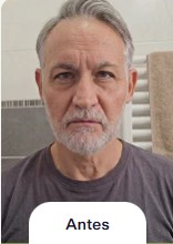 Foto anterior al uso de NOVARE