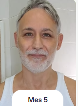 Foto posterior al uso de NOVARE